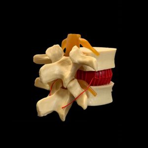 Макет позвонка с гемоцитом поясничного отдела позвоночника Макет позвонка с гемоцитом поясничного отдела позвоночника